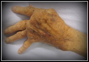 Rheumatoid_Arthritis 1